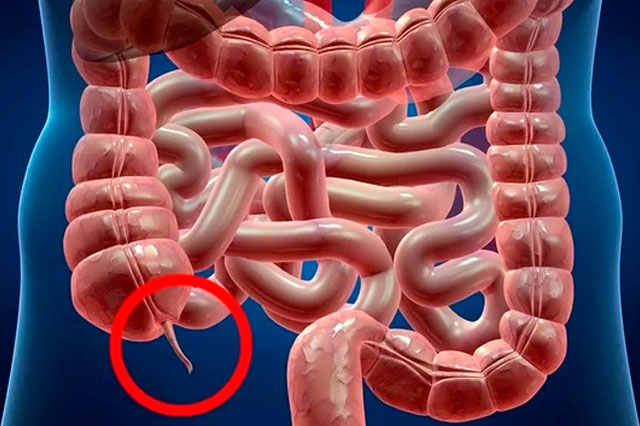 Dr Paulo Ramalho -  Apendicite